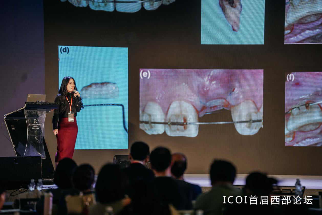 兰大口腔医院种植科殷丽华教授受邀参加首届icoi西部论坛并作大会报告